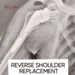 The ultimate guide to Do’s and Don’ts after Shoulder Replacement Surgery! Reverse Shoulder replacement surgery