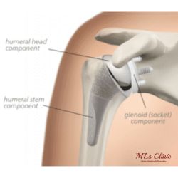 The ultimate guide to Do’s and Don’ts after Shoulder Replacement Surgery! Shoulder Replacement Surgery