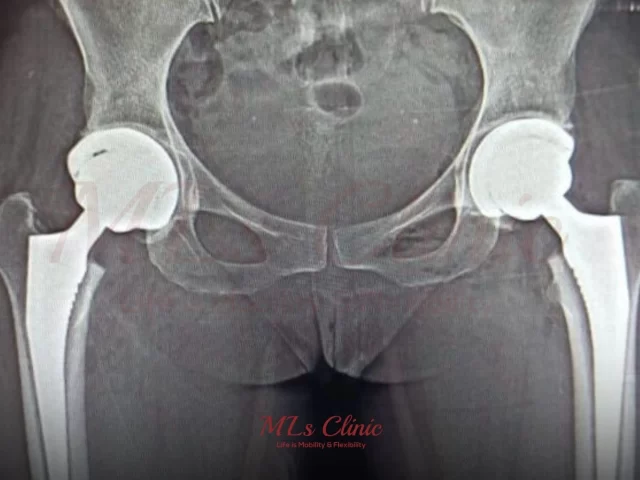 Metal, Ceramic, or Polyethylene? What Are the Best Types of Hip Implants?