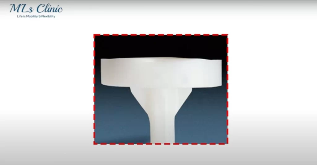 All Poly Implants Types of Knee Implants Dr Preetesh Choudhary