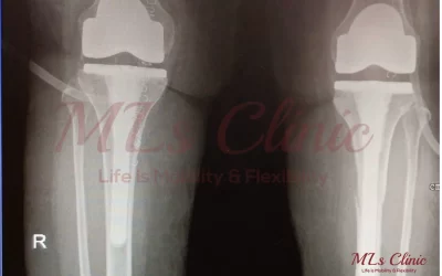 Bilateral Knee Replacement