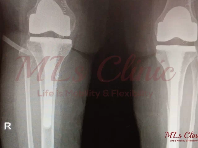 Two Knees, One Solution: Understanding Bilateral Knee Replacement.