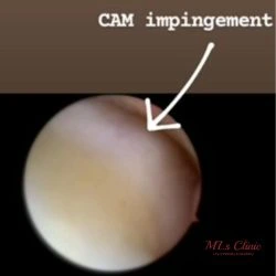 Hip Impingement (FAI) in Young Adults- Symptoms and Surgical Treatment Hip Impingement