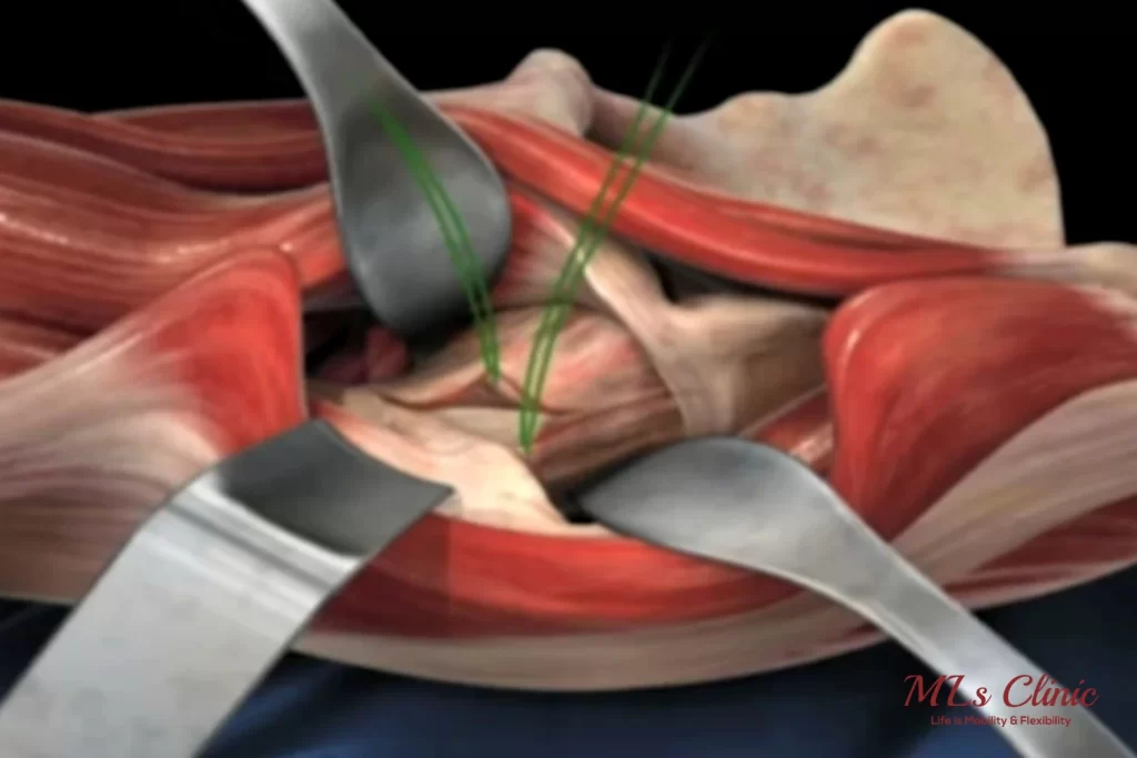 Hip replacement- Direct Anterior Approach(DAA) vs MIS Posterior Approach direct anterior approach