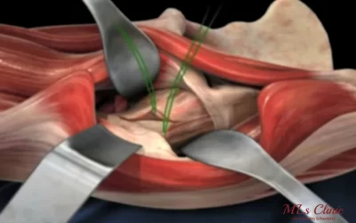 direct anterior approach