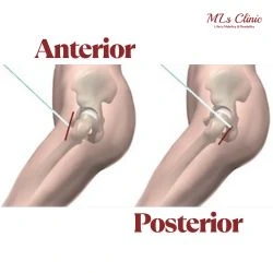 Hip replacement- Direct Anterior Approach(DAA) vs MIS Posterior Approach direct anterior approach
