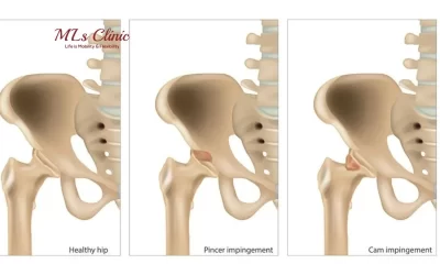Hip Impingement