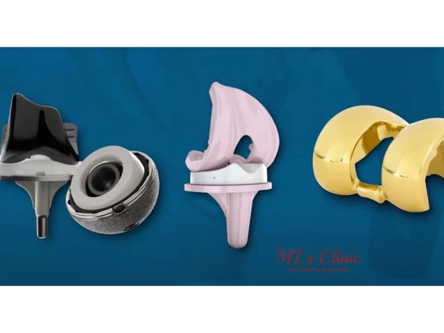 Knee Implant Materials: Titanium, Cobalt, Zirconia – Finding the Best Fit for You!